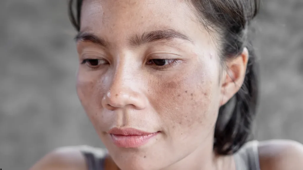 Melasma: como as manchas escuras transformam a vida de milhões- Mancha no rosto