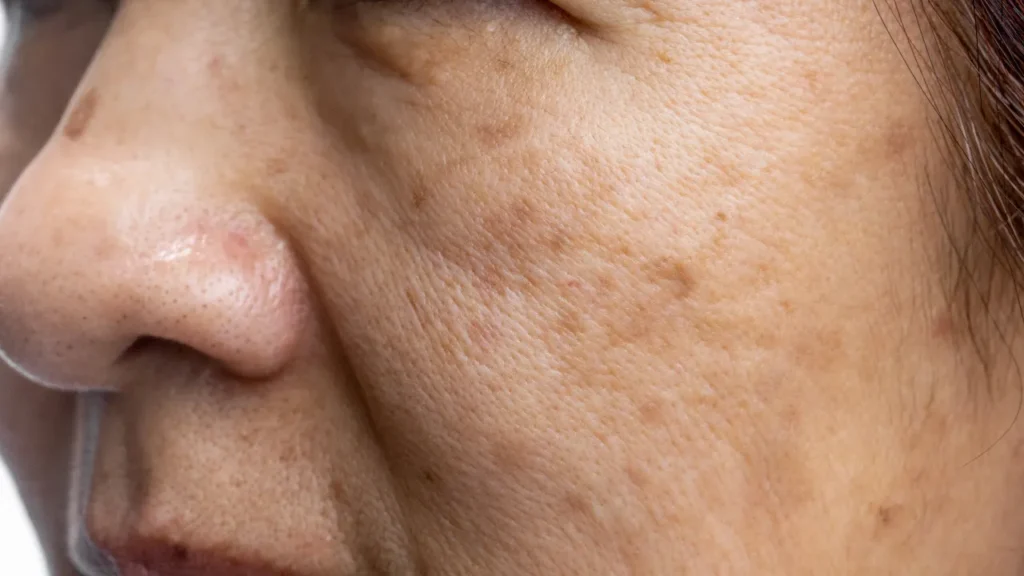 Melasma: como as manchas escuras transformam a vida de milhões