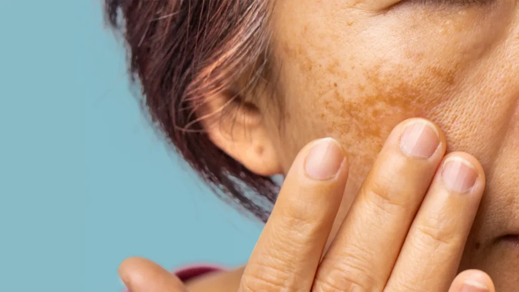 Melasma: como as manchas escuras transformam a vida de milhões Melasma: como as manchas escuras transformam a vida de milhões